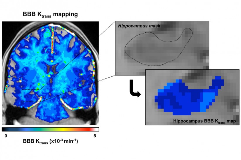 USC researchers used enhanced brain images to measure the blood-brain barrier's permeability, finding that the barrier becomes leaky with age. (Photo/Zlokovic Lab/Keck Medicine of USC).