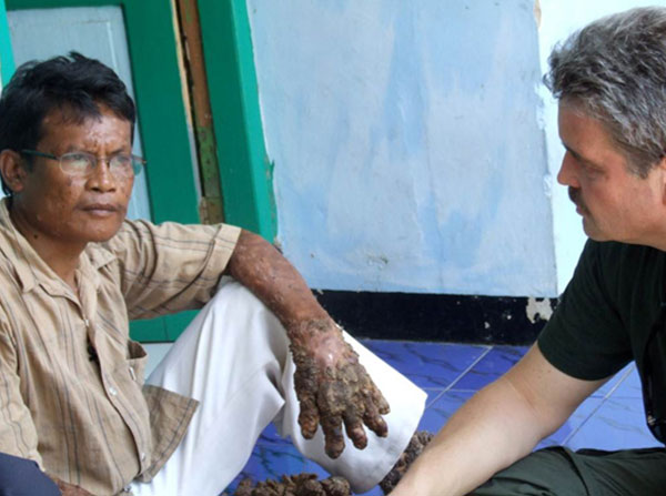 Martin Kast, PhD, of the USC Norris Comprehensive Cancer Center meets with one of the Indonesian "Treemen," who suffer from an uncontrolled infection and proliferation of warts caused by the human papillomavirus.