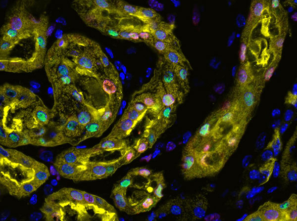 Activation of Sox9 (green) in nuclei (blue) of cellular lining (yellow) following acute nephron injury. Surviving SOX9+ cells proliferate (red) to repair the damaged nephron, restoring kidney function. (Image courtesy of the McMahon Lab )