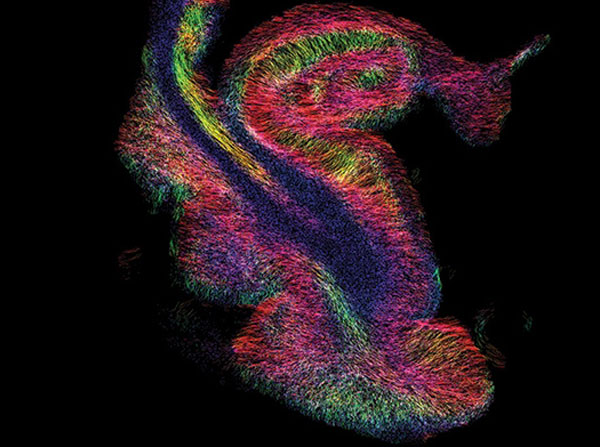 Colors in this brain MRI show the direction of fiber tracks within the hippocampus after Alzheimer's disease. Courtesy of the Laboratory of Neuro Imaging