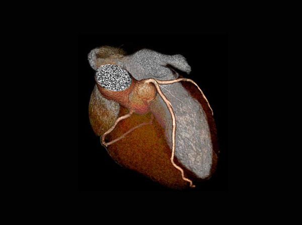 Researchers use CT scans to detect signs of subclinical coronary artery disease. (Photo/Multicenter AIDS Cohort Study)