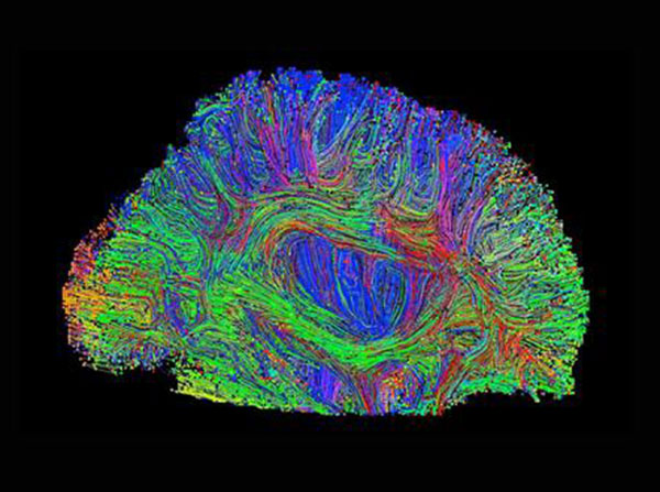 USC researchers lead an international team identifying seven genes that predict ‘intracranial volume’ and Parkinson’s disease