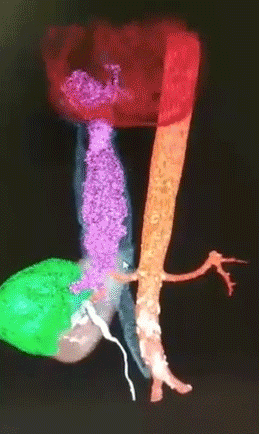 Doctors perform the first robotic surgery to remove kidney cancer extending into the heart