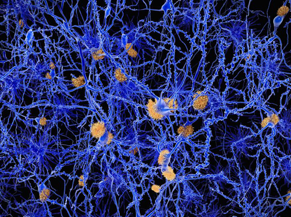 Amyloid Plaques