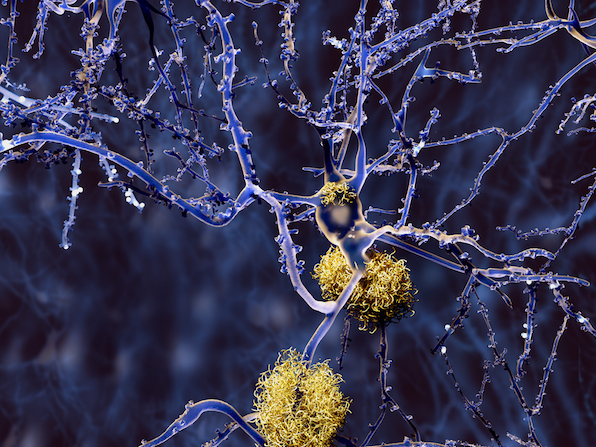 Amyloid plaques on a neuron