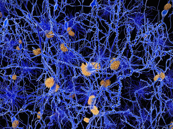 Amyloid Plaques