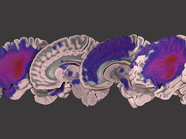 StrokeMRI_data