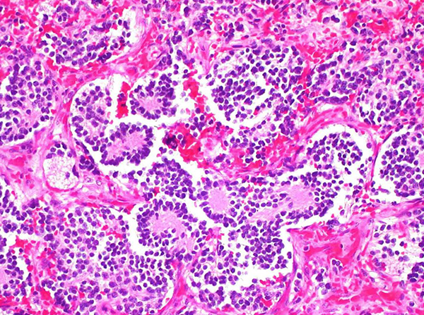 neuroblastoma