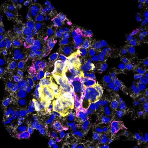 Metastatic breast cancer cells