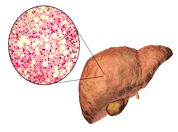 3D illustration of fatty liver and liver cells