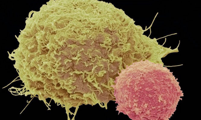 Advance in Groundbreaking Cancer Treatment Eliminates Severe Side Effects