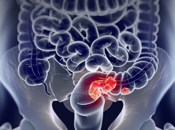 Improved treatment options for colorectal cancer could be on the horizon