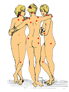 How to Diagnose and Manage Fibromyalgia