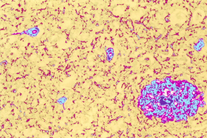 Colored light micrograph of brain tissue from an Alzheimer's disease sufferer. Both of the classic pathological features of this disease are seen here. Magnification: x50 at 6x7cm size.<br /> (Image/Simon Fraser, Science Source)