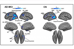 New study reveals one-two punch of symptoms that exacerbate Alzheimer’s