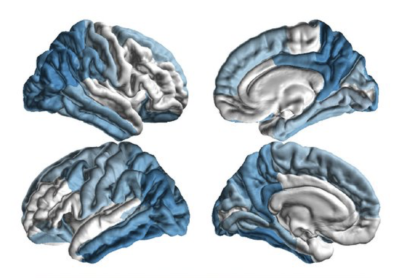 USC institute launches worldwide study of Parkinson’s disease