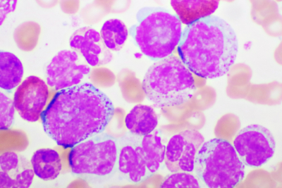 USC study identifies new risk factor for most common childhood cancer, Acute Lymphoblastic Leukemia