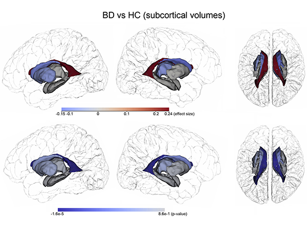 Promising new bipolar disorder study reveals structural brain changes over time