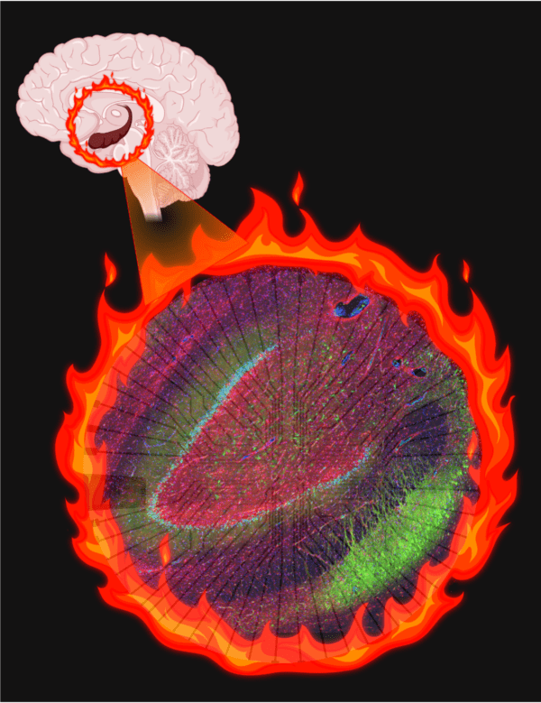 Altered cells create an electrical “fire” in patients with epilepsy.