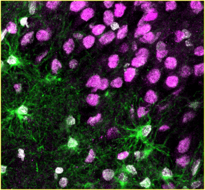 Newborn astroglia (green) in brain tissue from human epilepsy patients (Image by Aswathy Ammothumkandy/Bonaguidi Lab/USC Stem Cell)