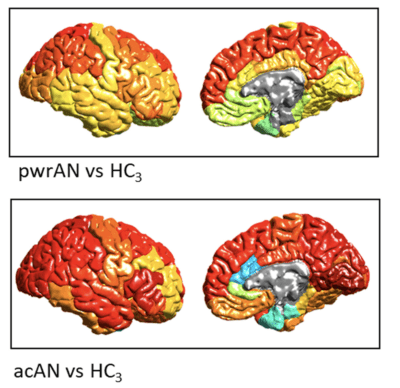 Brain Shrinkage in Anorexia: Compiled from worldwide brain scans in the largest study to date, these brain maps show (in warmer colors) brain regions with gray matter deficits—abnormal tissue reductions—in anorexia. Deficits are less strong in partially-weight restored individuals (upper images) than those in the acute phase (lower images) suggesting the importance and benefits of early interventions. (Photo credit: ENIGMA Anorexia Working Group)