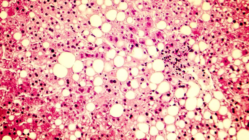 Fatty liver, liver steatosis. Photomicrograph showing large vacuoles of triglyceride fat accumulated inside liver cells, it occurs in alcohol overuse, under action of toxins, in diabetes