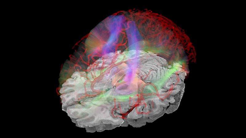 Diffusion tensor imaging (DTI) tracts and cerebral blood vessels within the brain. DTI is an MRI‑based neuroimaging technique that makes it possible to estimate white matter tracts of the brain.