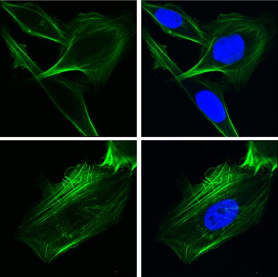 Researchers from the Keck School of Medicine of USC used imaging techniques to study how the protein GRP78 controls cancer cell behavior. In the top row, human lung cancer cells were engineered to over-express GRP78 in the nucleus. In the bottom row, cells lacked GRP78 in the nucleus. The green staining depicts the cytoskeletal protein F-actin which controls cell shape and motility and the blue staining depicts the nucleus. (Image courtesy of Ze Liu, Ph.D, and Amy Lee, PhD)