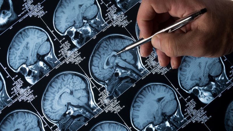 MRI Brain Scan of head and skull with hand pointing