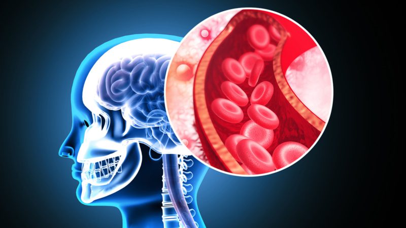 Atherosclerosis Stroke. A blood clot in the vessels of the human brain. 3d illustration